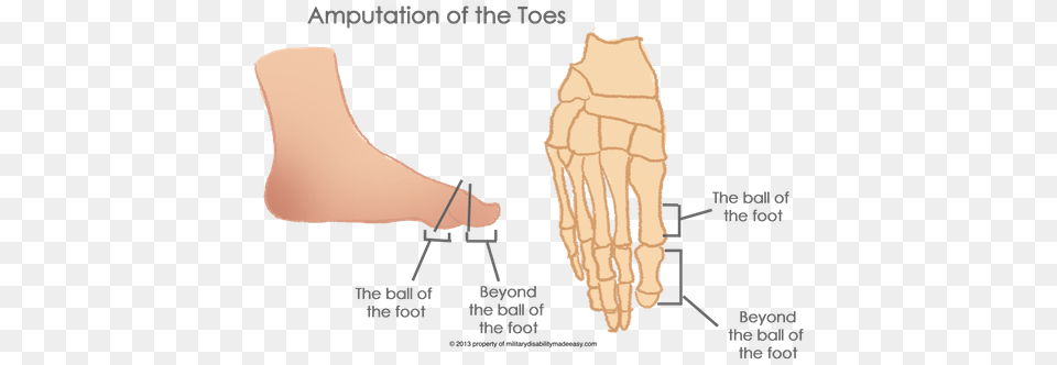 The Amputation Of The Toes 6 Hallux Amputation, Massage, Person Free Png
