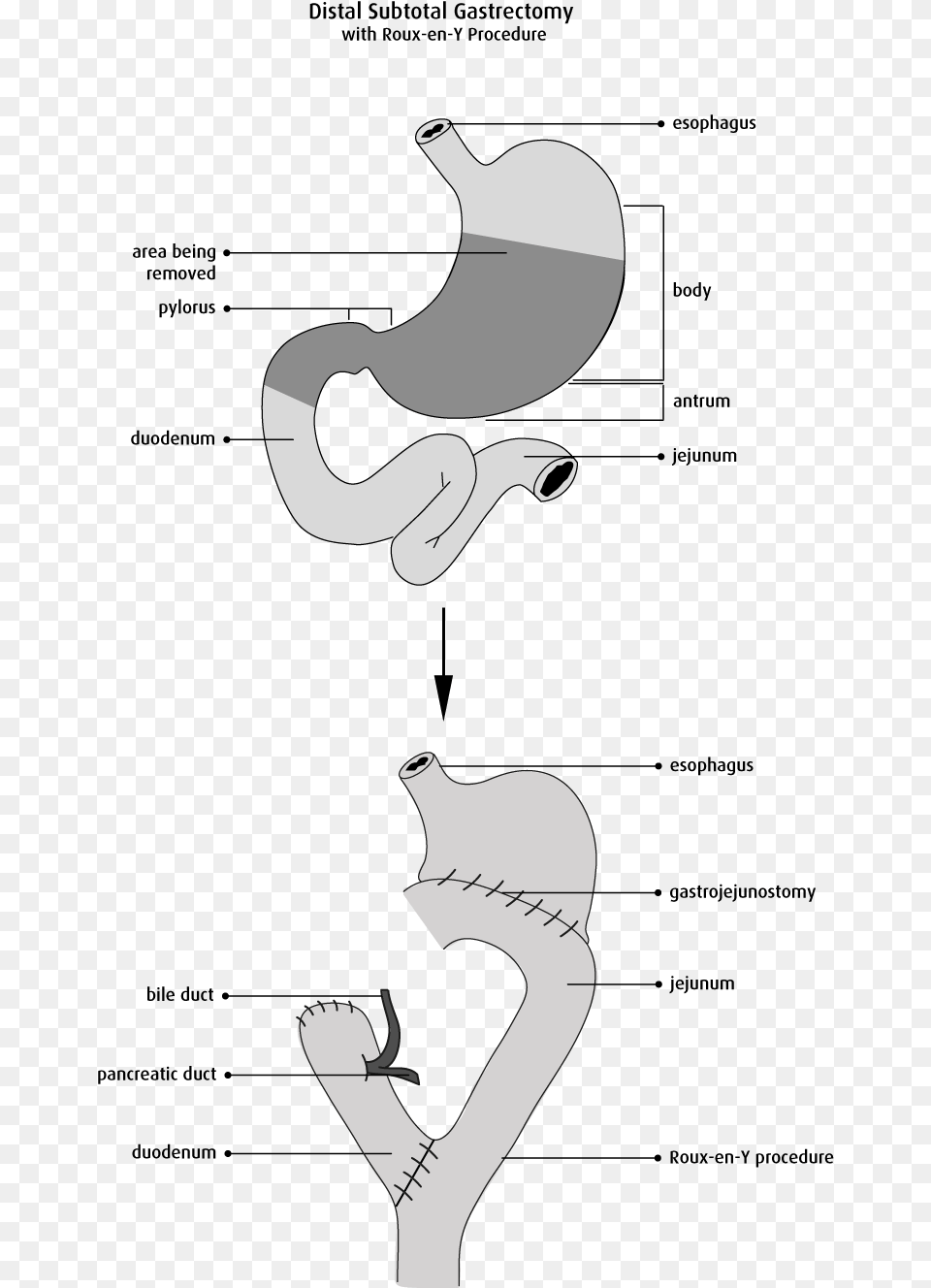 The Bile Duct Is Moved To Enter The Remaining Part Totally Laparoscopic Distal Gastrectomy, Lighter, Baby, Person Png