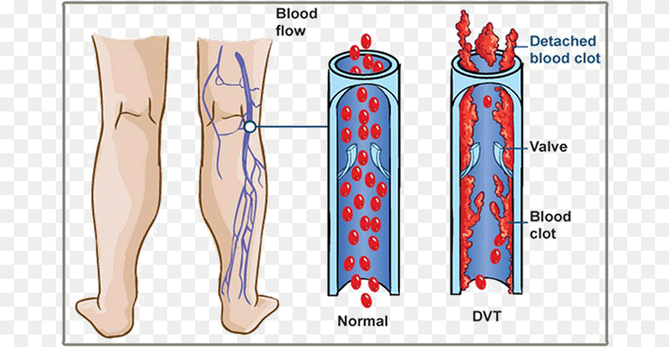 The Danger Of Dvt Deep Vein Thrombosis, Chart, Plot, Body Part, Person Free Png Download