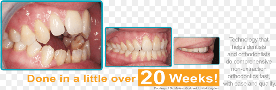 The Decision To Get Braces Can Be Scary One, Body Part, Mouth, Person, Teeth Free Png Download
