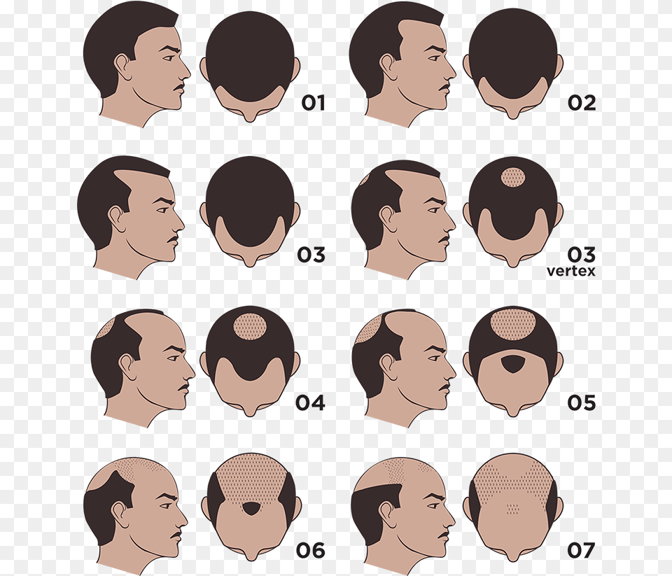 The Norwood Scale, Head, Person, Face, Man Free Png