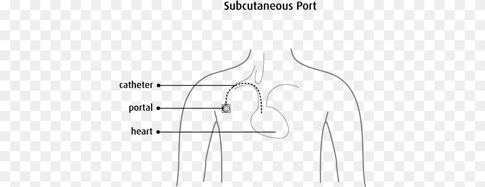 The Nurse Inserts A Special Type Of Needle Through Subcutaneous Port Catheter, Spider Web Png Image