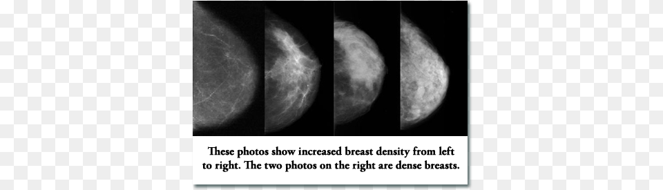The Problem With High Density Breasts Is That Tumors Dense Breast Mammogram, Astronomy, Moon, Nature, Night Free Png Download