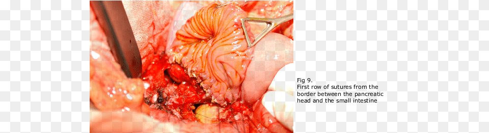 The Resection Of The Pancreatic Head With Conservation Pancreas With Chronic Pancreatitis Transparent, Hospital, Architecture, Building, Jewelry Free Png Download