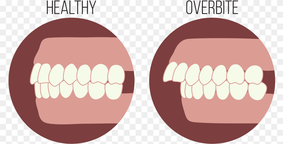 The Steps To Overbite, Body Part, Mouth, Person, Teeth Free Transparent Png