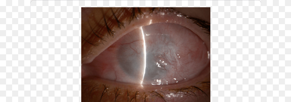 Third Degree Alkali Chemical Burn Os 24 Months After Chemical Burn, Baby, Person, Contact Lens Free Png Download