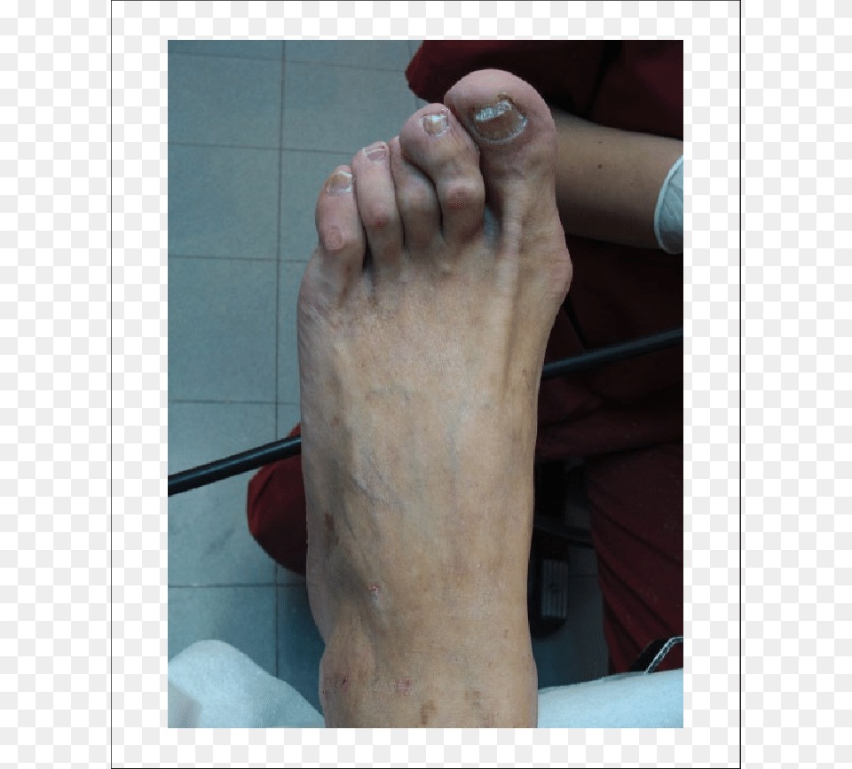 This Bone Prominence Is Highly Associated With Ulcers Hammer Toe, Ankle, Body Part, Person, Adult Free Transparent Png