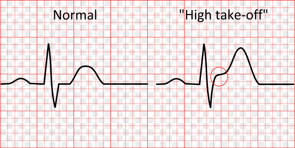 This Normal Variant Of The Ecg Represents Early Repolarisation Normal Ecg Vs St Elevation, Chart Free Transparent Png