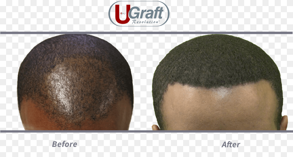 This Patient Benefited From 1400 Grafts Safely Extracted Buzz Cut, Head, Person, Face, Body Part Free Png Download