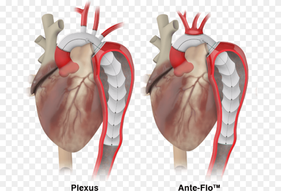 Thoraflex Hybrid, Heart Free Png