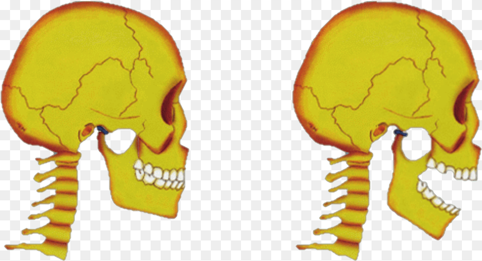 Tmj Disorders Jaw Joint Pain Skull, Baby, Person, Head, Ct Scan Png