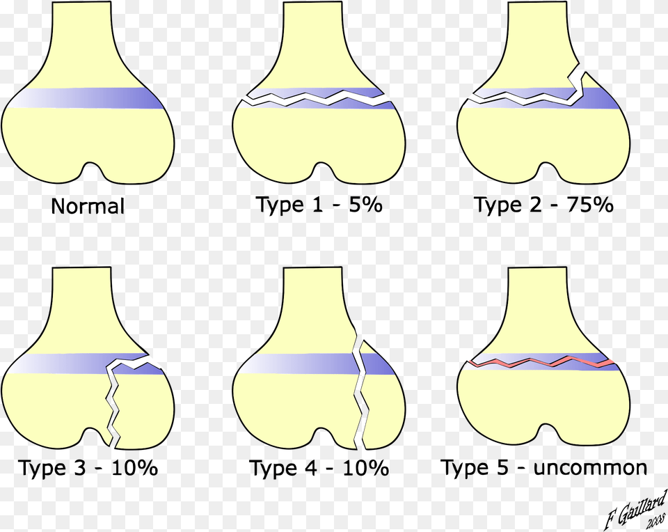 Tracing Worksheet Letter F Further Solving Literal Fracture Salter Et Harris, Light, Jar, Person Png