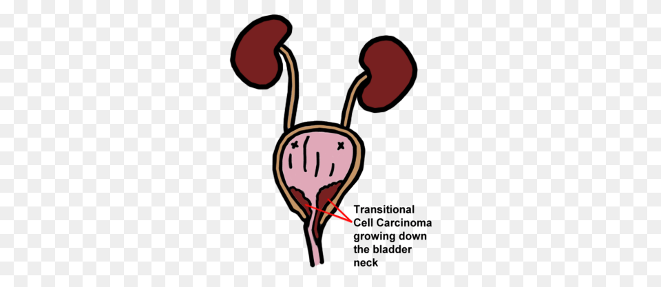 Transitional Cell Carcinoma, Food, Fruit, Plant, Produce Png Image