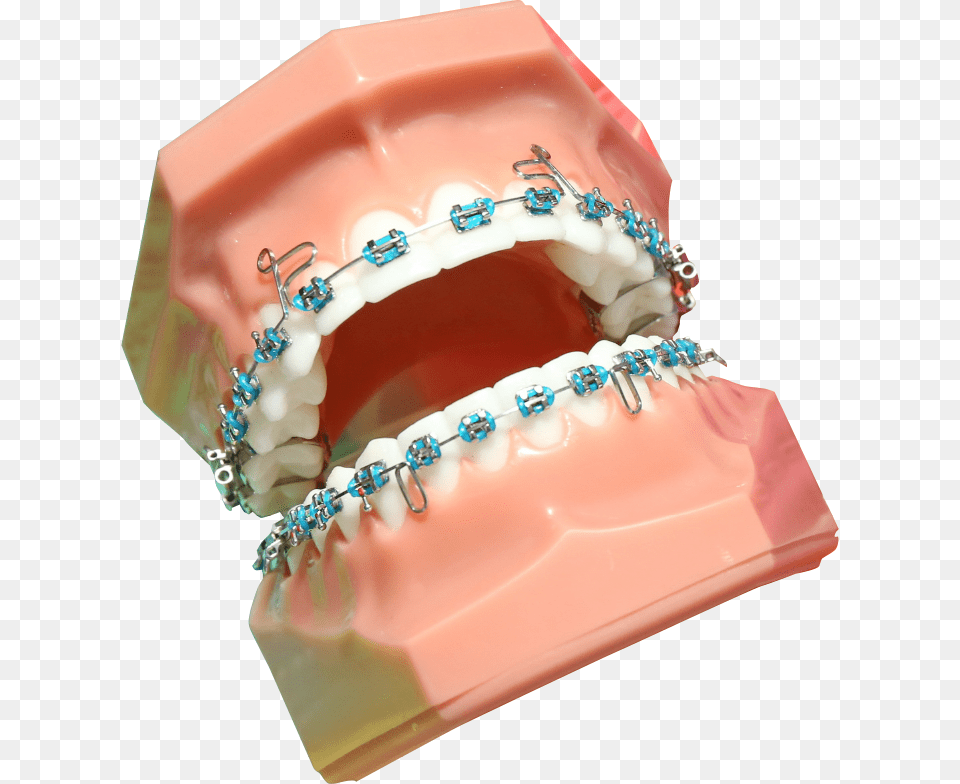 Transparent Braces Rodzaje Aparatw Ortodontycznych Staych, Face, Head, Person, Body Part Free Png Download