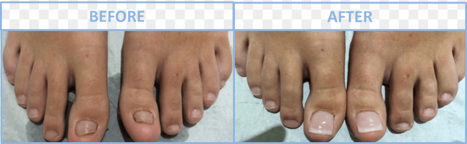 Transparent Fingernail Toe Nail Reconstruction Surgery, Body Part, Person, Baby Free Png Download