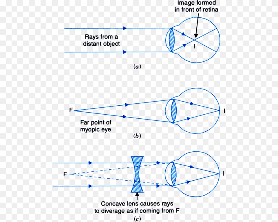 Transparent Human Eyes Correction Of Myopic Eye, Chart, Plot Png Image