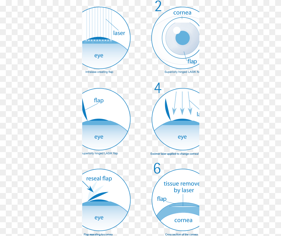 Transparent Procedure Eye Laser Surgery Steps, Sphere, Disk Free Png