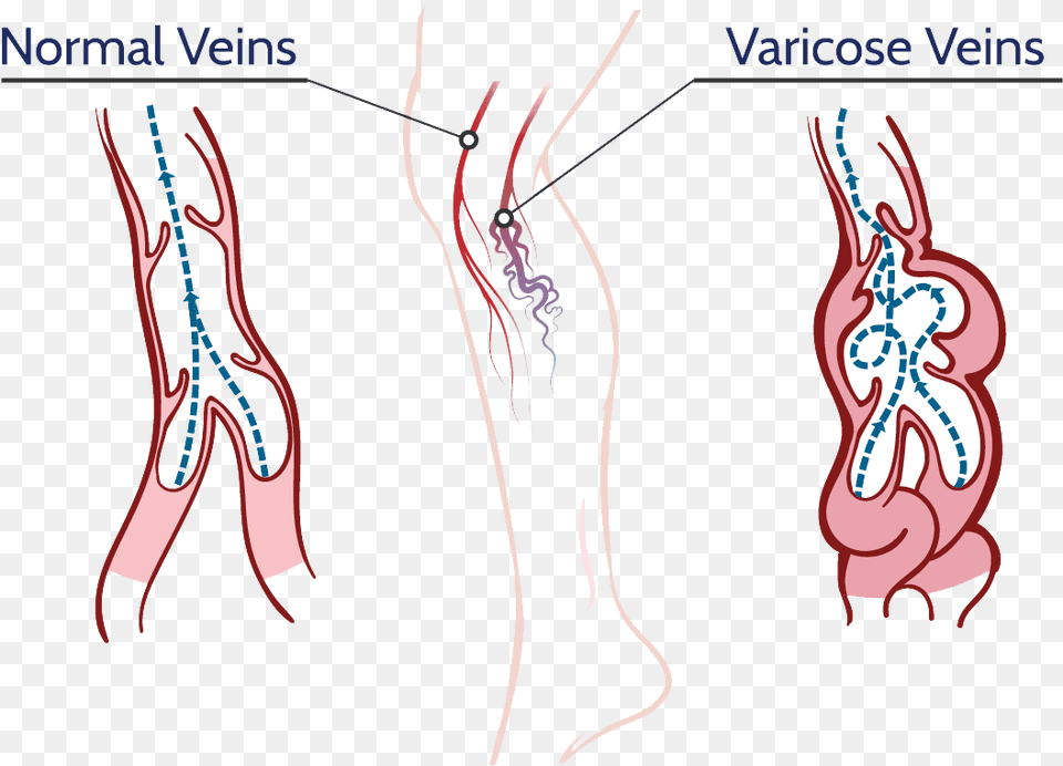 Veins Varicose Vein Pencil Diagram Free Transparent Png