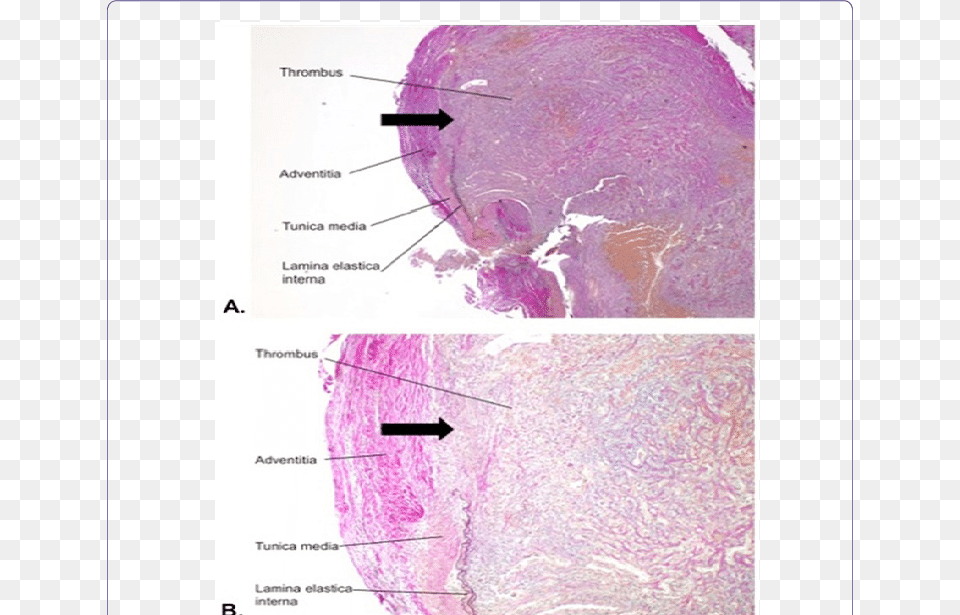 Transverse Section Of The Pseudoaneurysm Pseudoaneurysm, Purple Free Transparent Png