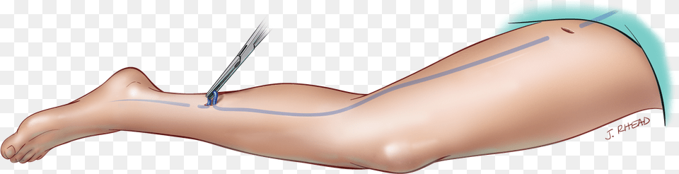 Treatment Vein Stripping Leather, Arm, Body Part, Person, Adult Free Transparent Png