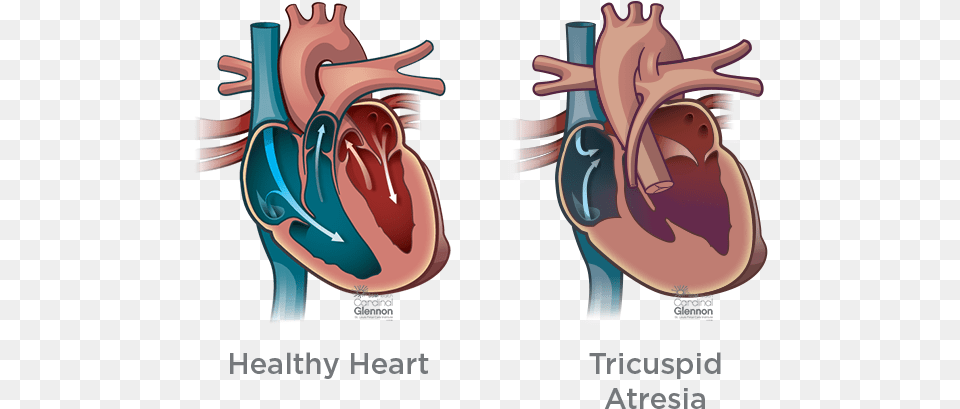 Tricuspatresia Truncus Arteriosus Heart, Qr Code, Smoke Pipe, Ct Scan Png Image