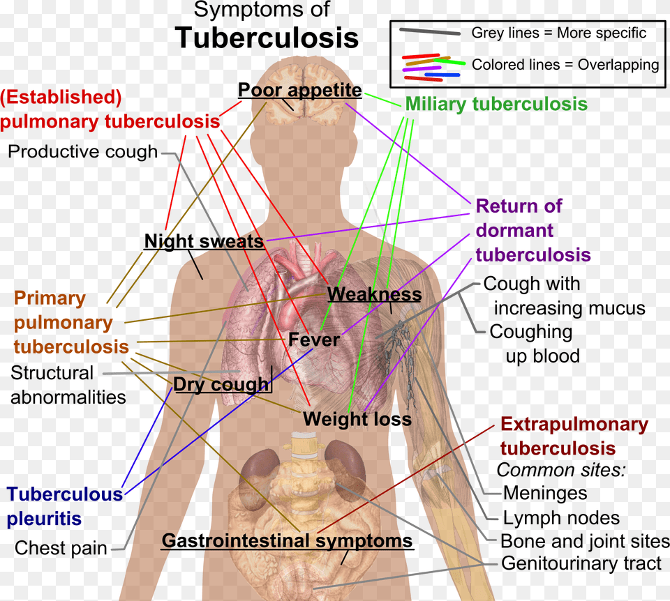 Tuberculosis Symptoms Tuberculosis Tests, Adult, Male, Man, Person Png Image