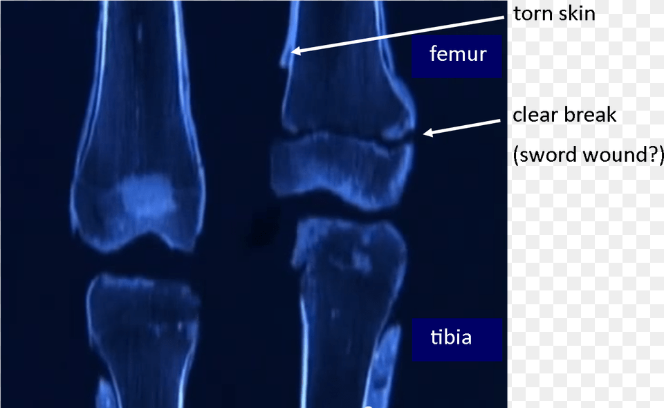 Tut S Leg Bones Radiography, Ct Scan, Adult, Female, Person Png Image