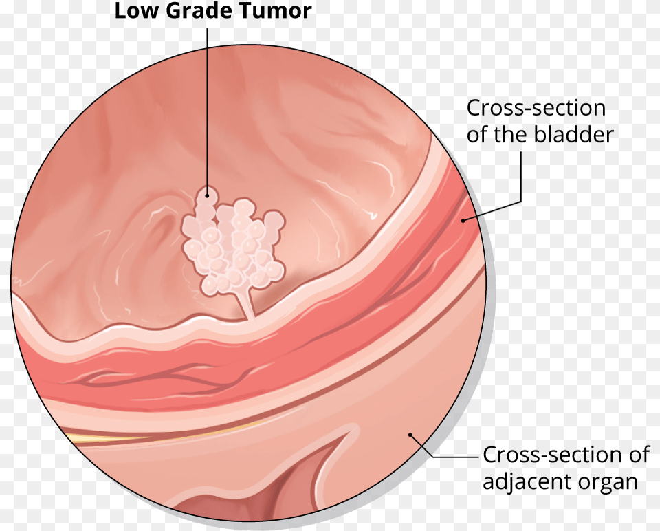 Types Of Bladder Cancer, Food, Meat, Pork, Meal Free Png