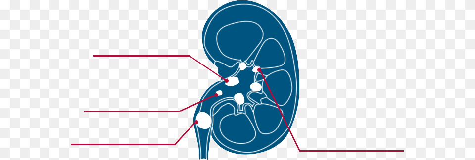 Types Of Kidney Stones Graphic Design Free Png Download