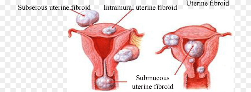 Types Of The Patients39 Uterine Fibroids Table Fibroid Uterus Types Png