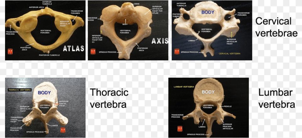 Types Of Vertebrae Anatomy, Ct Scan, Adult, Person, Man Free Png Download