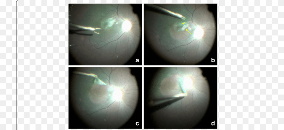 Typical Video Images Of The Surgical Process Tissue, Flare, Light, Lighting, Sphere Png Image
