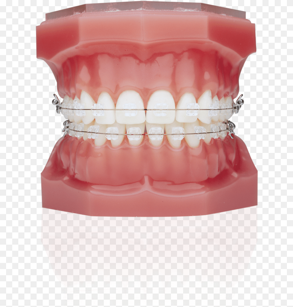 Typodont With Braces, Body Part, Face, Head, Mouth Free Png