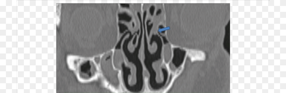 Uncinate Process Adheres With Middle Concha In Left Ethmoidal Infundibulum, Ct Scan Png