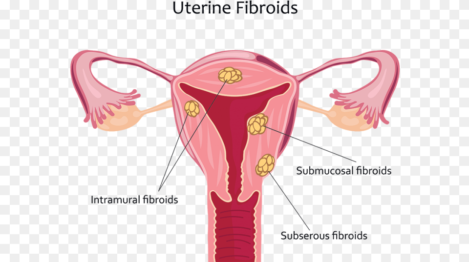 Uterine Fibroids Uterine Fibroid, Heart, Body Part, Face, Head Free Png Download
