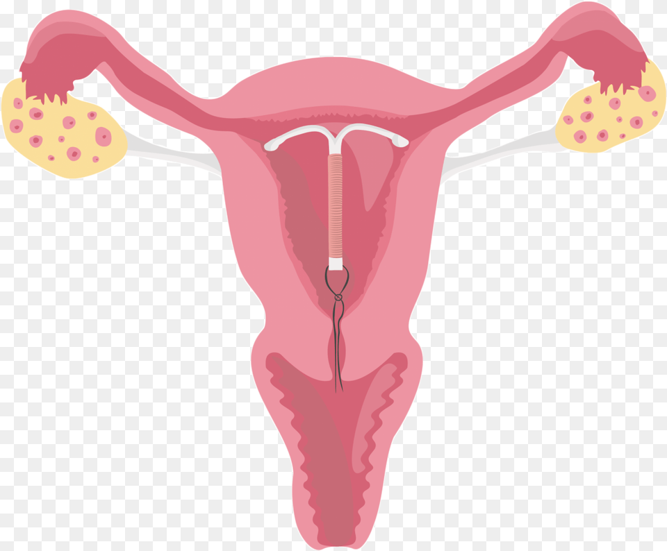 Uterus Female Reproductive System With Iud, Baby, Person, Body Part, Mouth Free Png Download