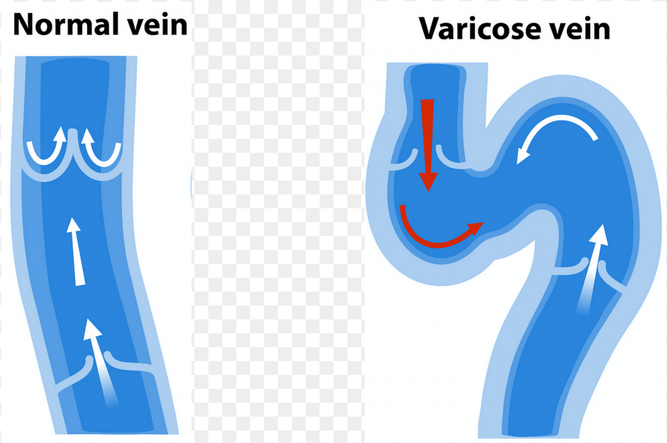 Varicose Vein Symptoms Normal Vein Vs Varicose Vein, Text Free Png