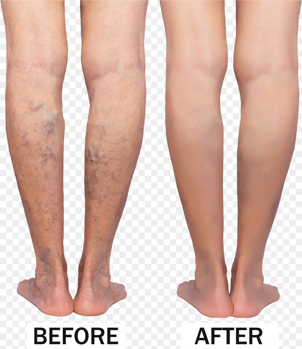 Varicose Veins Before Amp After Sclerotherapy Before And After Free Png Download