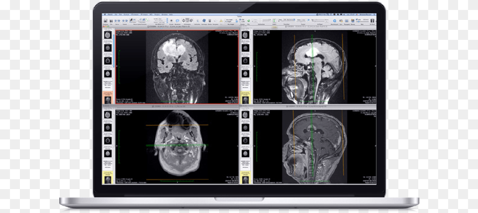 Viewer Osirix For Mac, Ct Scan, Computer Hardware, Electronics, Hardware Free Png Download