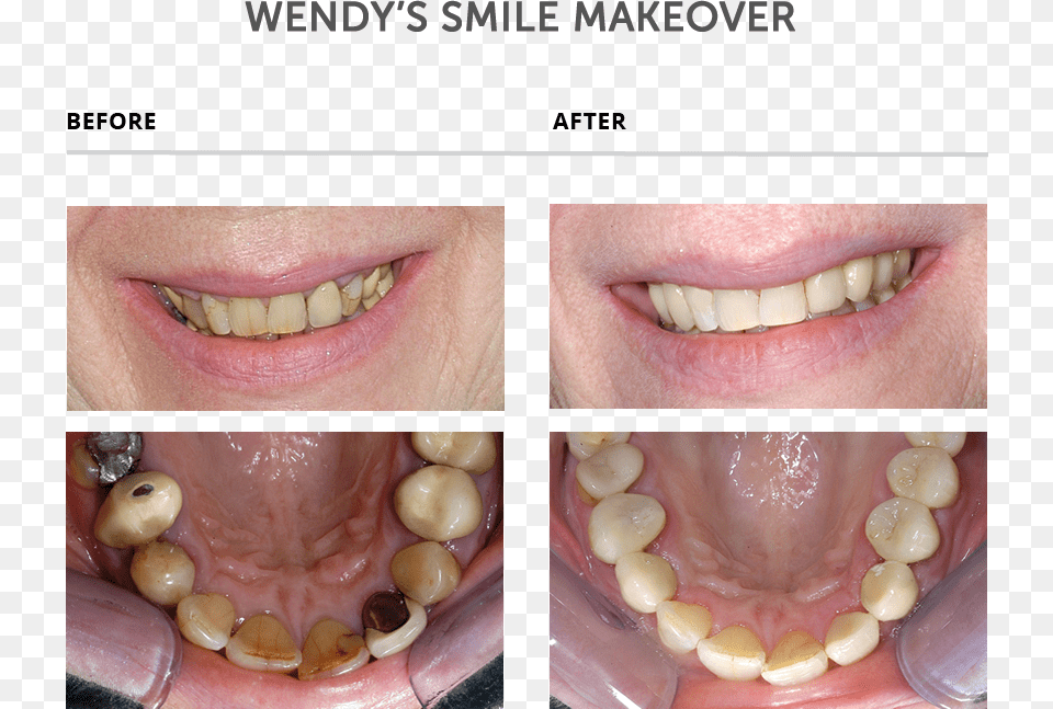 Weybridge Teeth Smile Makeover Teeth Makeover, Body Part, Mouth, Person, Face Free Png Download