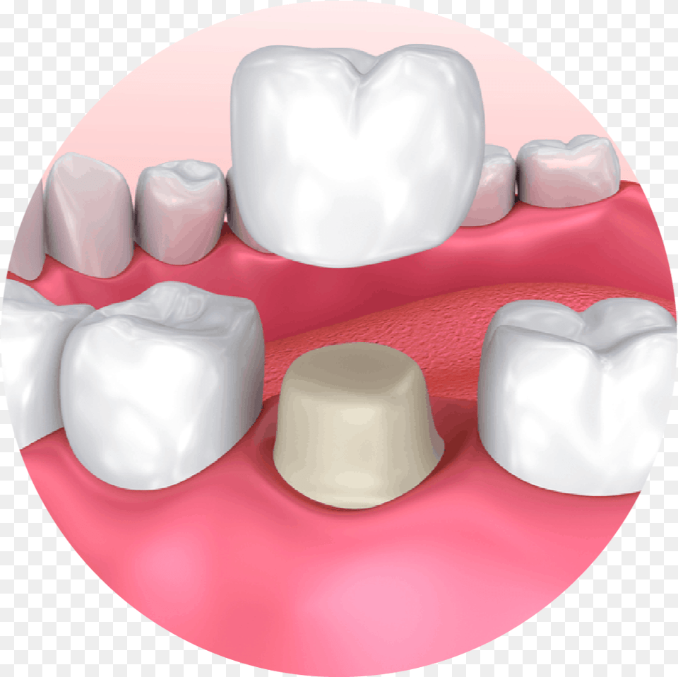 What Is A Dental Crown Dental Crown, Body Part, Mouth, Person, Teeth Free Png Download