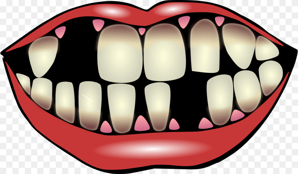What Leads To Missing Teeth Dentist In San Marcos Dr Michael, Body Part, Mouth, Person Png Image