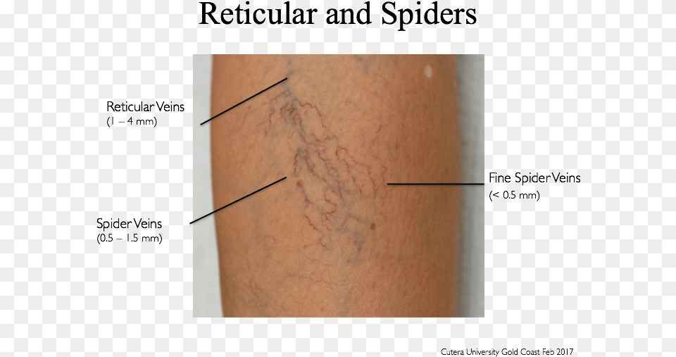 What Not To Treat Hits The Spot Spider Vein Treatment Cutera, Person, Skin, Body Part, Knee Png Image
