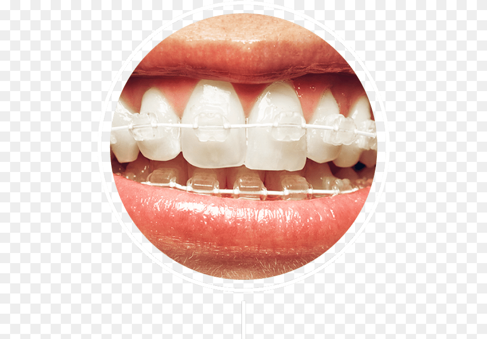 White And Silver Braces, Body Part, Mouth, Person, Teeth Free Transparent Png