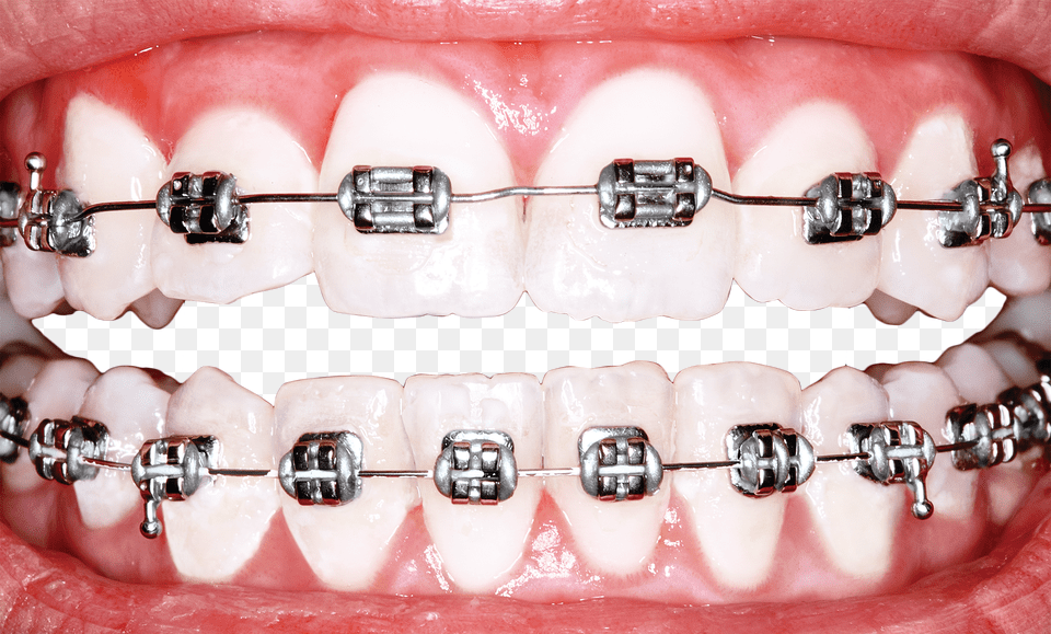 Why Is America Obsessed With Perfect Teeth Science Braces For Teeth Free Png Download