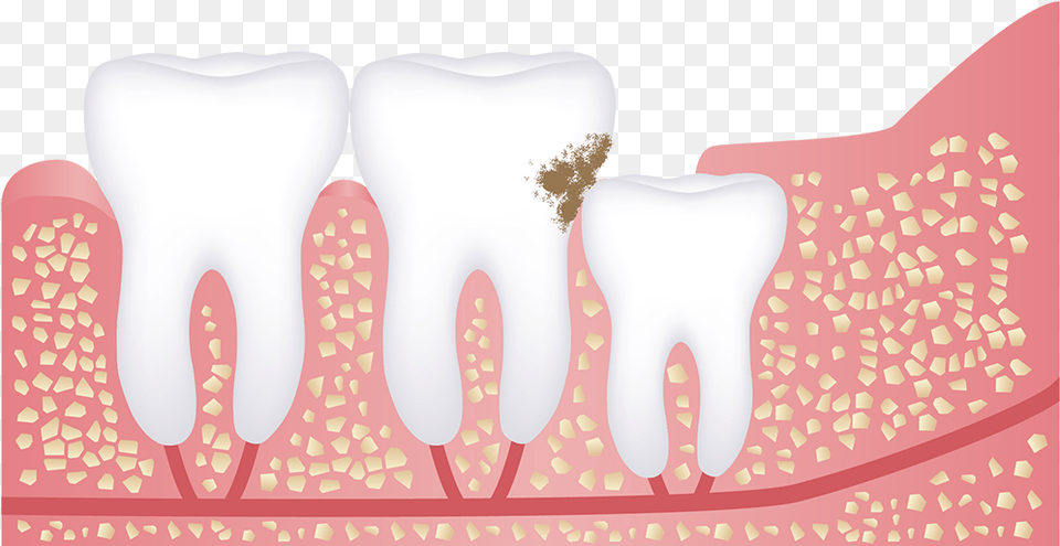 Wisdom Tooth Tooth Decay My Wisdom Tooth Hurting, Body Part, Mouth, Person, Teeth Free Png