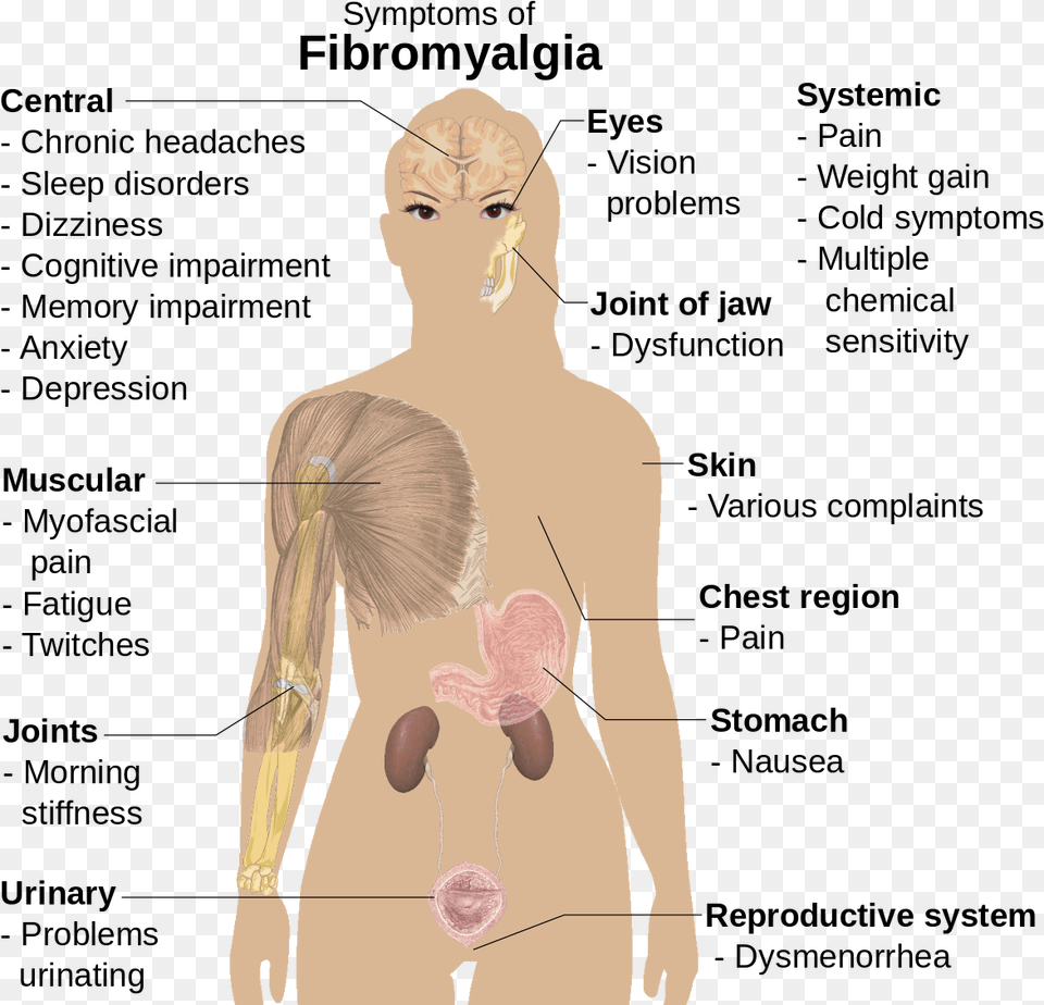 Woman Fibromyalgia Trigger Points, Adult, Female, Person, Body Part Free Png Download
