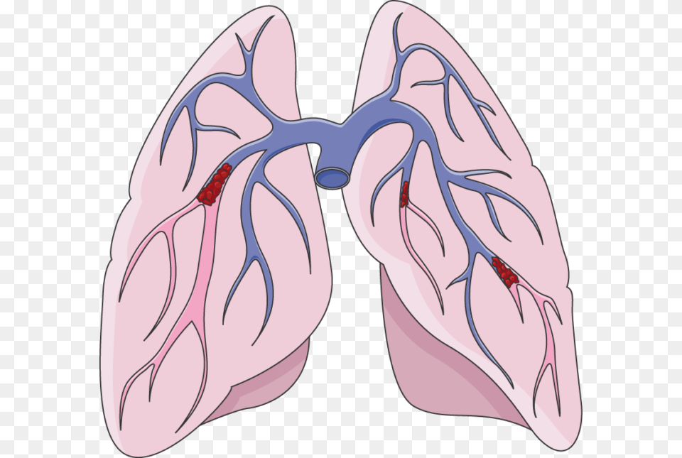 X 645 1 Pulmonary Embolism Clip Art, Heart, Person Png