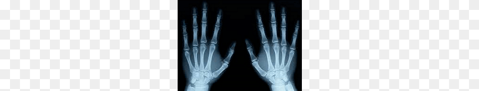 X Ray Of Both Hands, X-ray Free Png