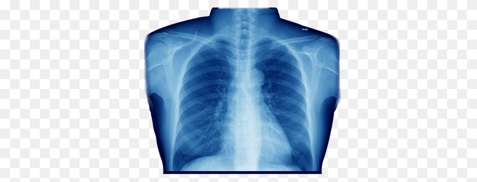 X Ray Of Chest, X-ray Free Png Download